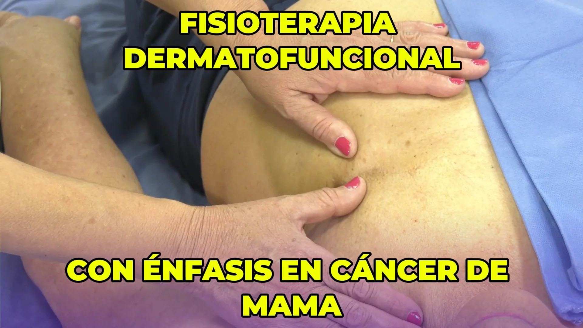 Fisioterapia Dermatofuncional con Énfasis en Cáncer de mama