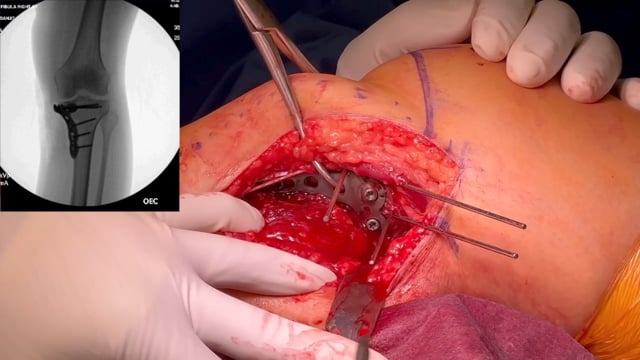 Open Reduction and Internal Fixation of a Moore Type I Medial Tibial Plateau Fracture-Dislocation