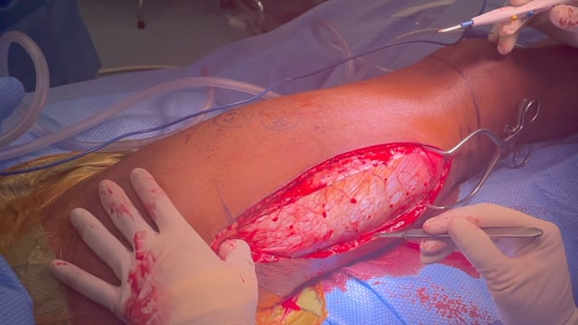 Surgical Release of Thigh Compartment Syndrome