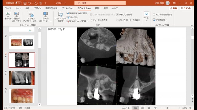 歯根側方病変の逆根管治療｜吉岡隆知先生(Archives)