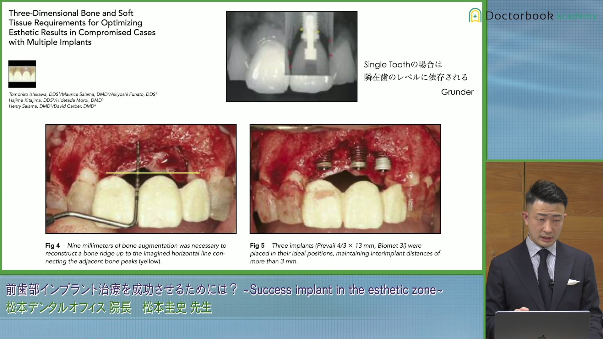  臨床知見録_GBR_Bone Peakの考え方