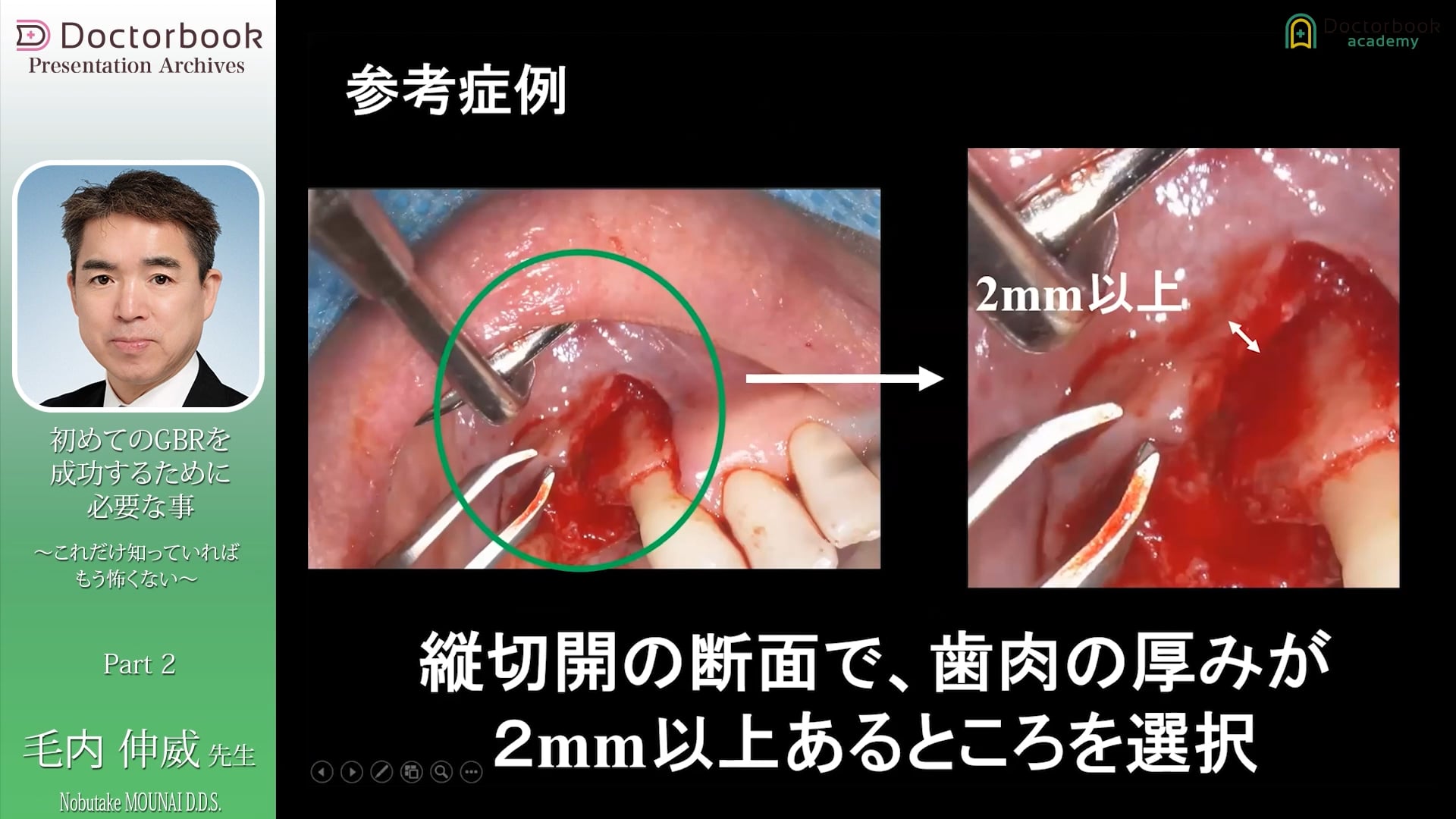  臨床知見録_GBR_減張切開 参考症例