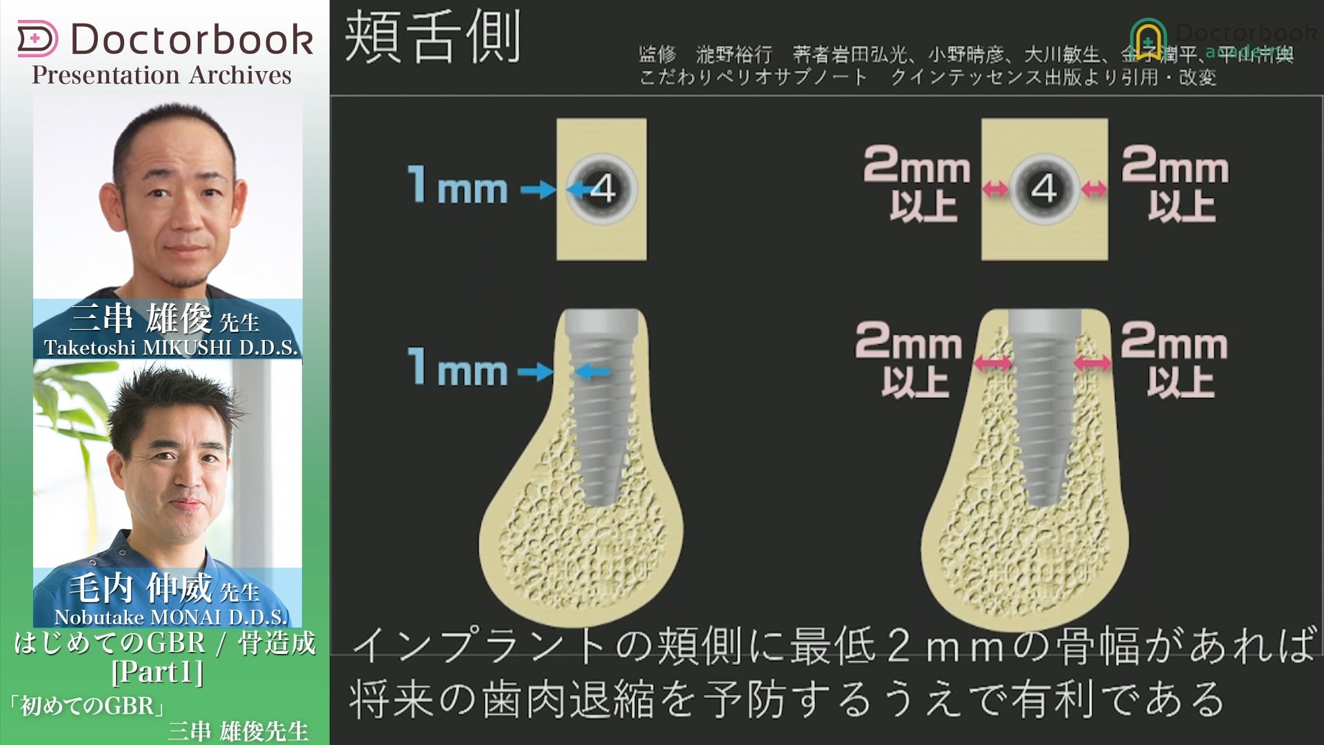  臨床知見録_GBR_インプラントに関する論文