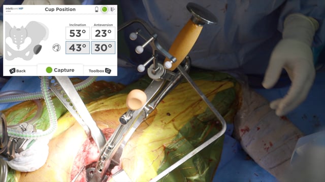 Cementing a Monoblock Dual Mobility Implant Into a Fully Porous Acetabular Shell in Revision Total Hip Arthroplasty