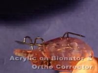 Bionator Acrylic Adjustment