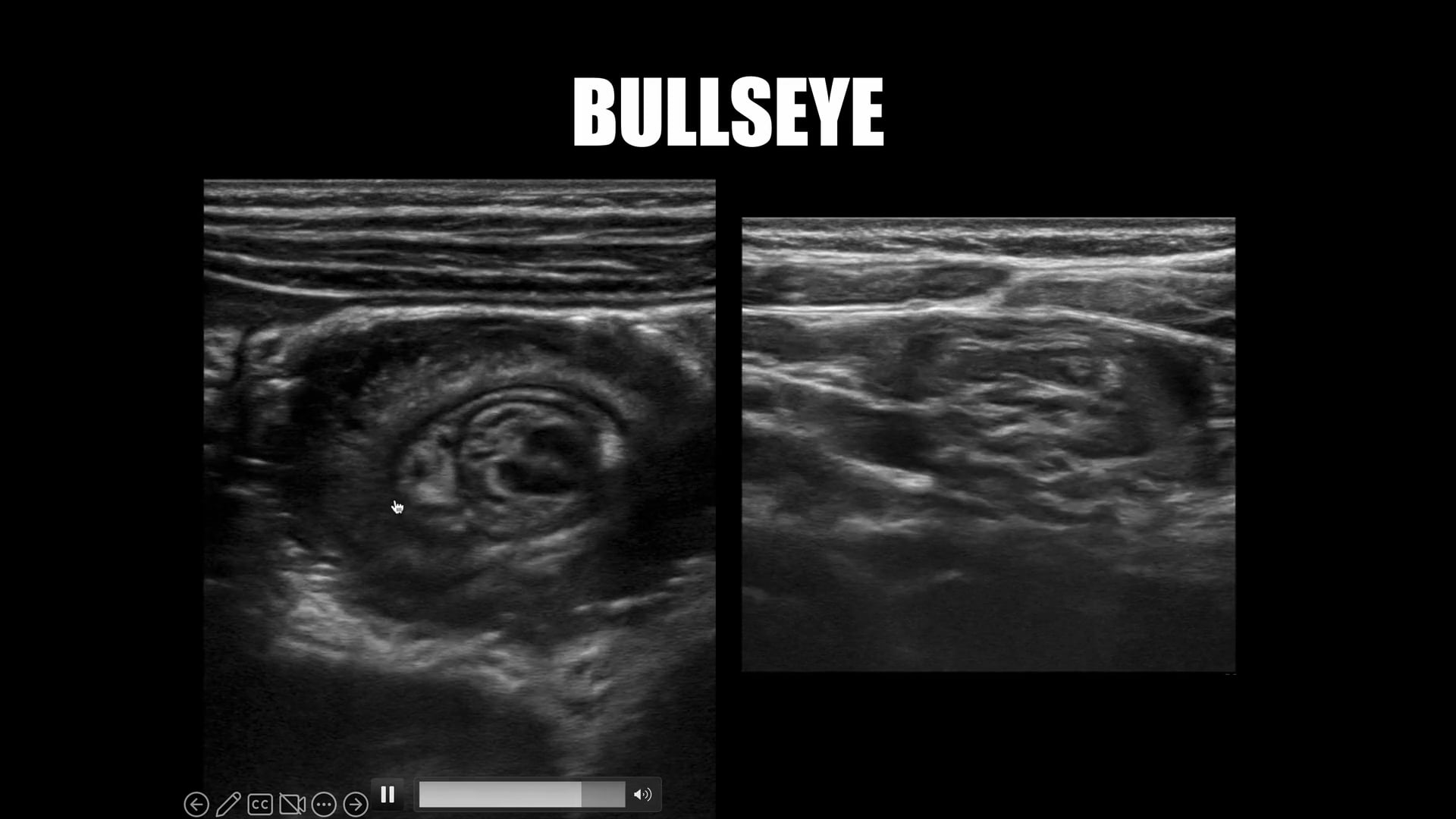 Vomiting Child-Part 2: Intussusception