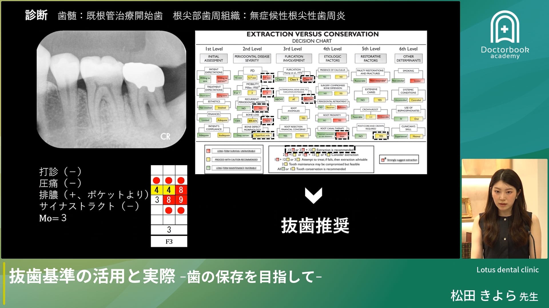 抜歯基準の活用と実際 - 歯の保存を目指して -