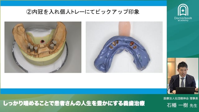 しっかり噛めることで患者さんの人生を豊かにする義歯治療 - 10年以上保たせられる自費パーシャルデンチャー -