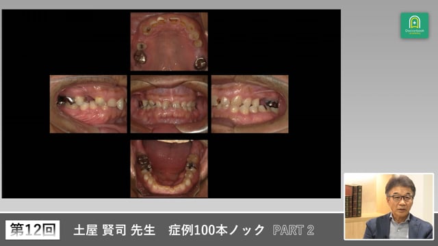 力のコントロールを軸にした全顎的診断とステップ設計 #2