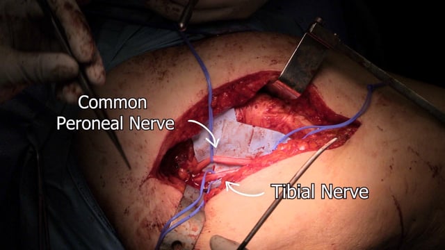 Sciatic Nerve Common Peroneal Nerve Neurolysis