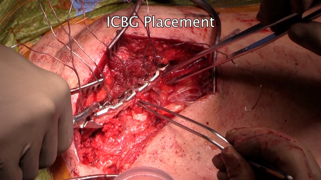 Scapulothoracic Arthrodesis with the use of ICBG Autograft