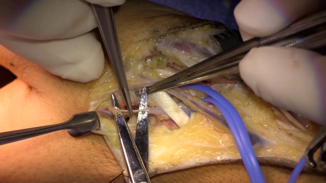 Lunate Reconstruction with Medial Femoral Trochlea Microvascular Free Flap