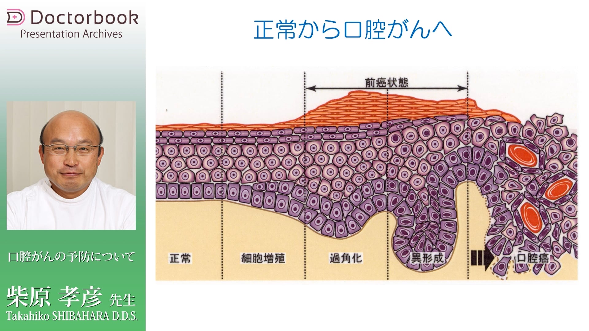  臨床知見録_口腔がん_正常から口腔がんへ