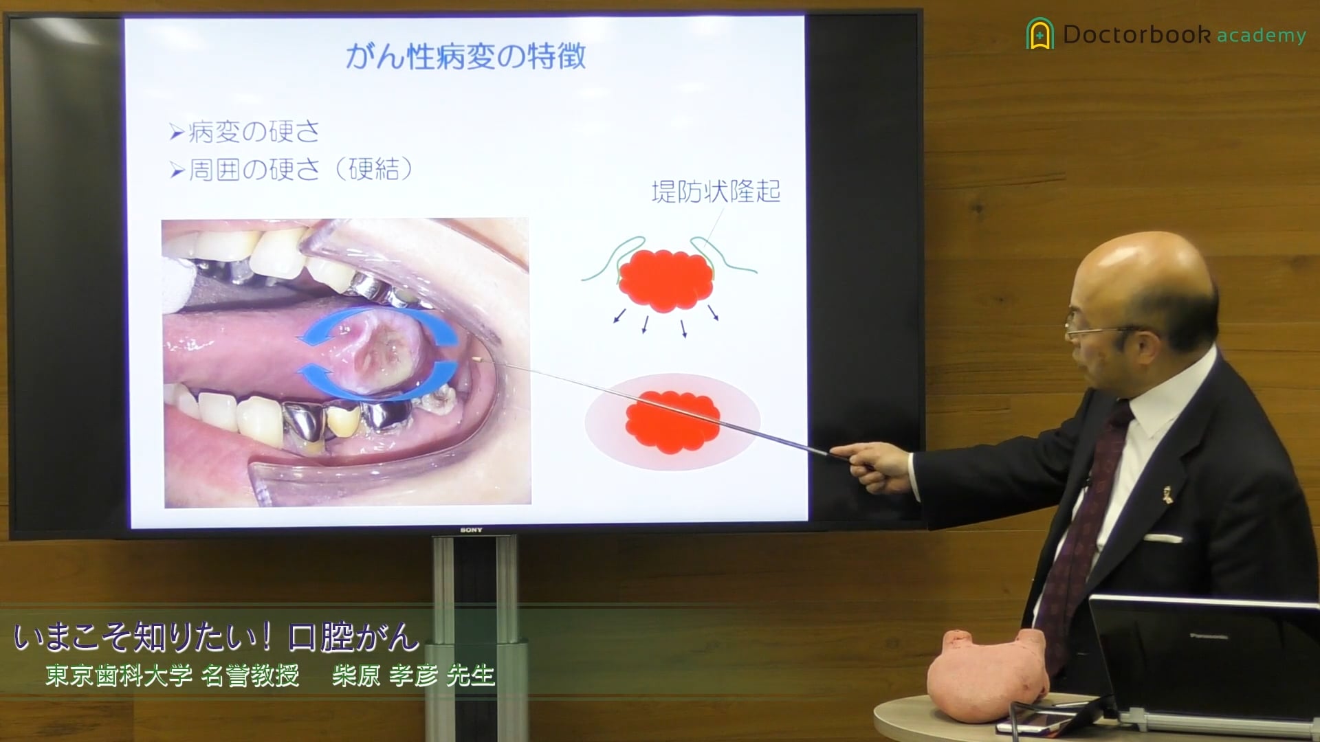  臨床知見録_口腔がん_硬結について