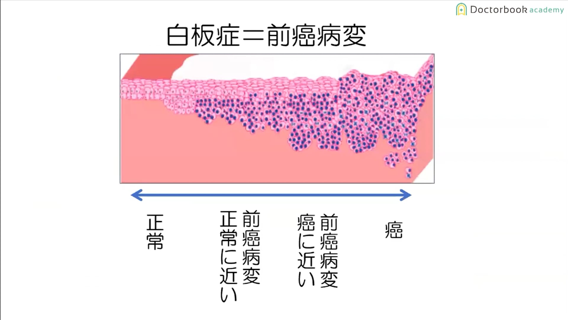  臨床知見録_口腔がん_白板症について