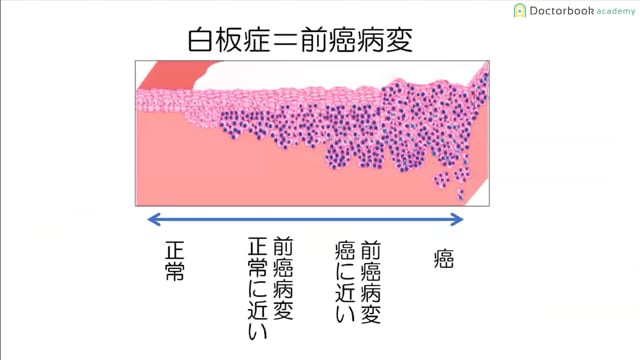  臨床知見録_口腔がん_白板症について