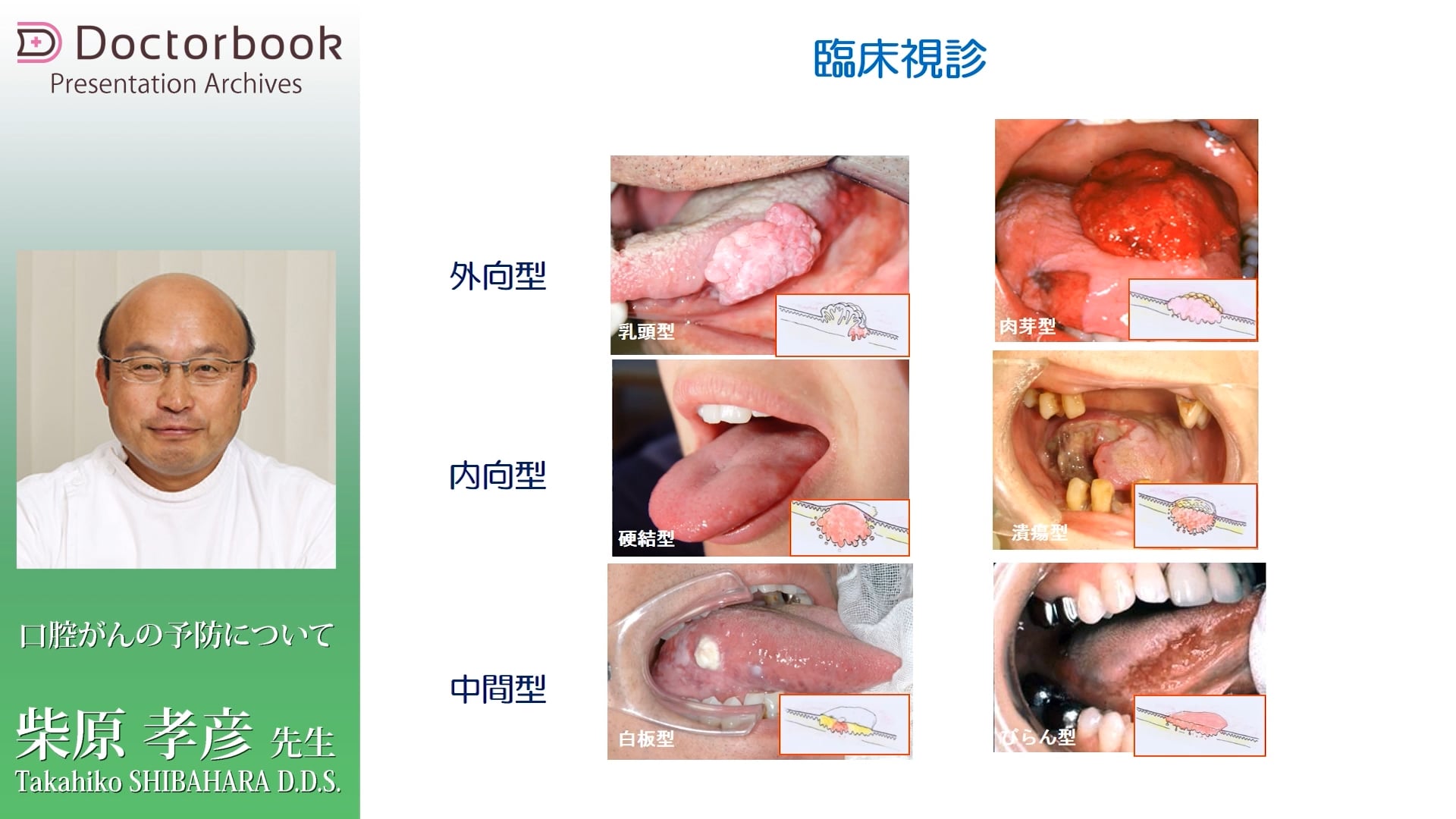  臨床知見録_口腔がん_臨床視診について