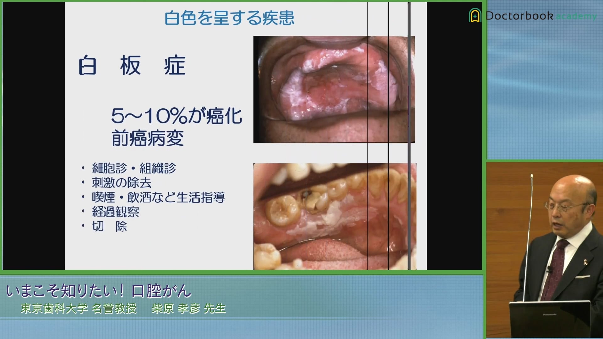  臨床知見録_口腔がん_白板症まとめ