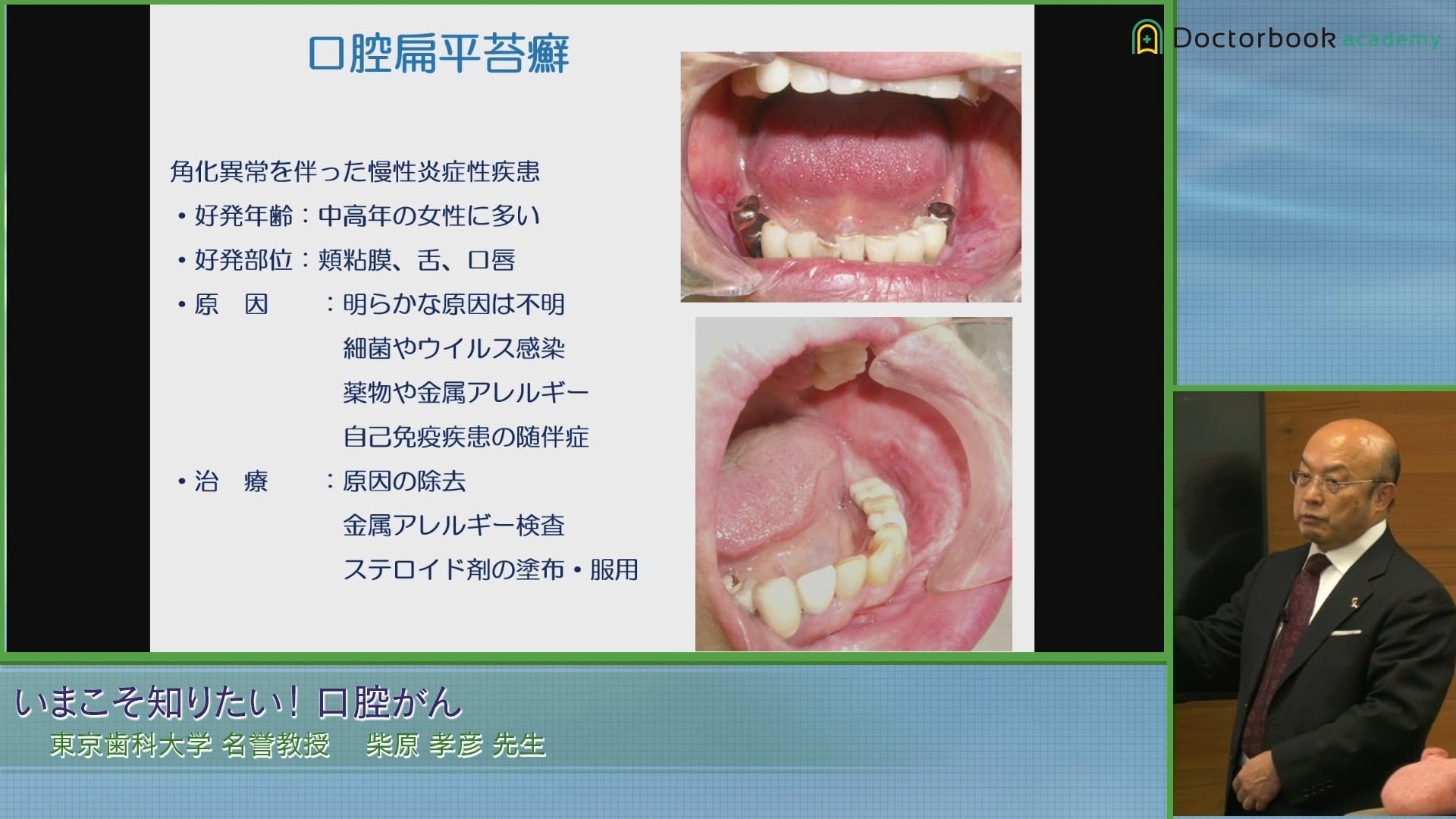  臨床知見録_口腔がん_口腔扁平苔癬まとめ