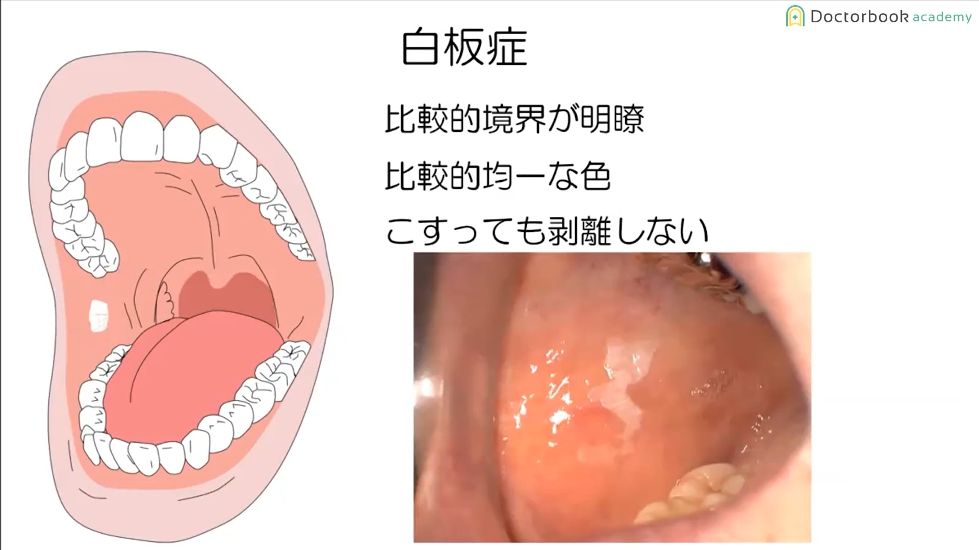  臨床知見録_口腔がん_白板症の特徴