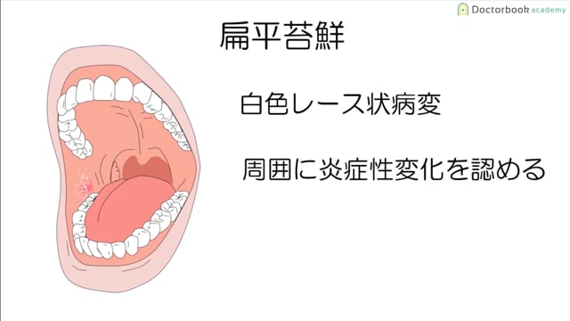  臨床知見録_口腔がん_扁平苔癬について
