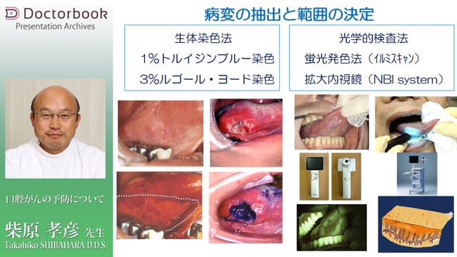  臨床知見録_口腔がん_病変の抽出と範囲の決定