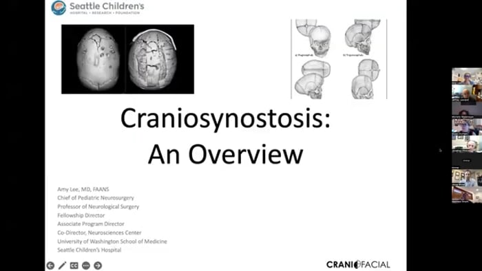 Craniosynostosis, an Overview 