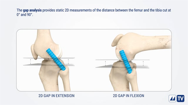 4D MyBalance NextAR Knee