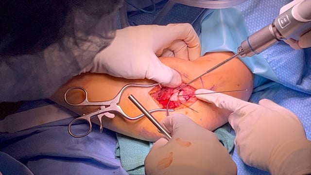 Radial Head Fracture: Open Reduction and Internal Fixation with Tripod Technique