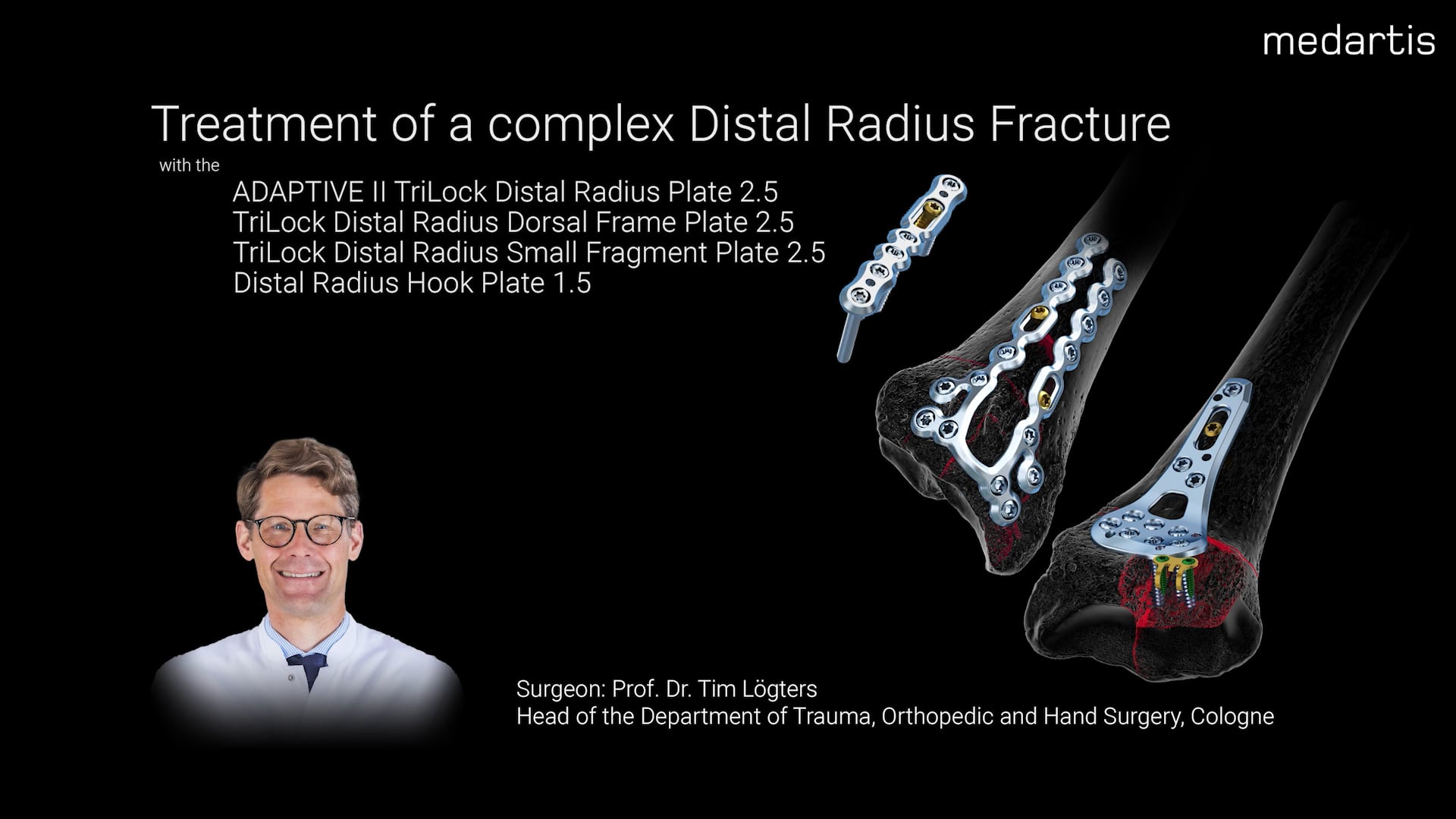Treatment of a complex Distal Radius Fracture