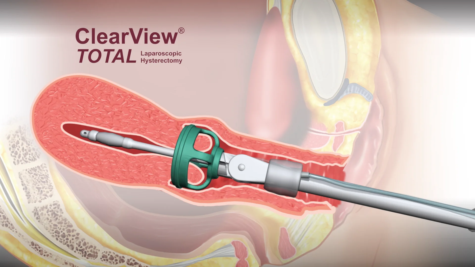 子宮マニピュレーター トータル | 婦人科用機器 | 製品情報 | アトム