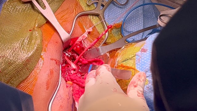 Posterior Sternoclavicular Joint Dislocation and Reconstruction