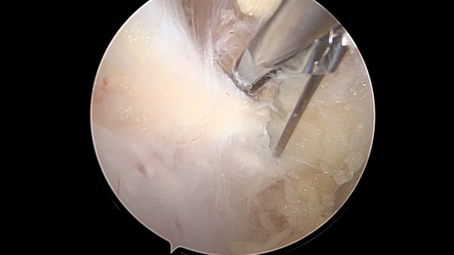 Arthroscopic Suprascapular Nerve Decompression