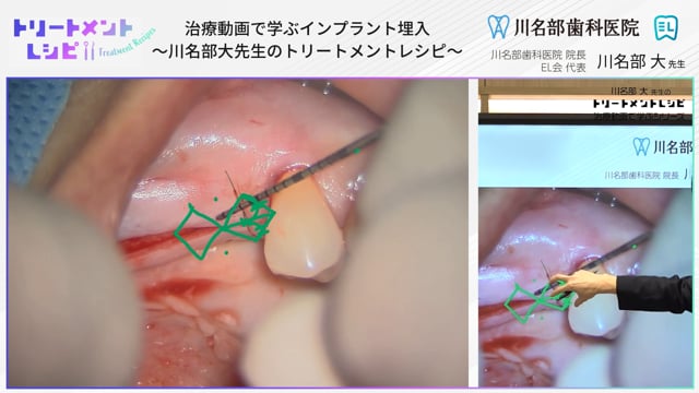 治療動画で学ぶインプラント埋入〜川名部大先生のトリートメントレシピ〜