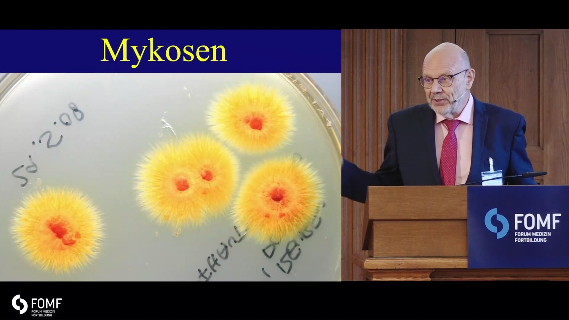 Kombinationstherapie bei superinfizierten Mykosen 