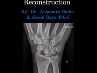#LiveSurgeryTuesday Scapholunate LigamentReconstruction