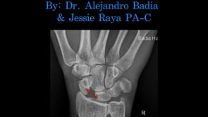 #LiveSurgeryTuesday Scapholunate LigamentReconstruction