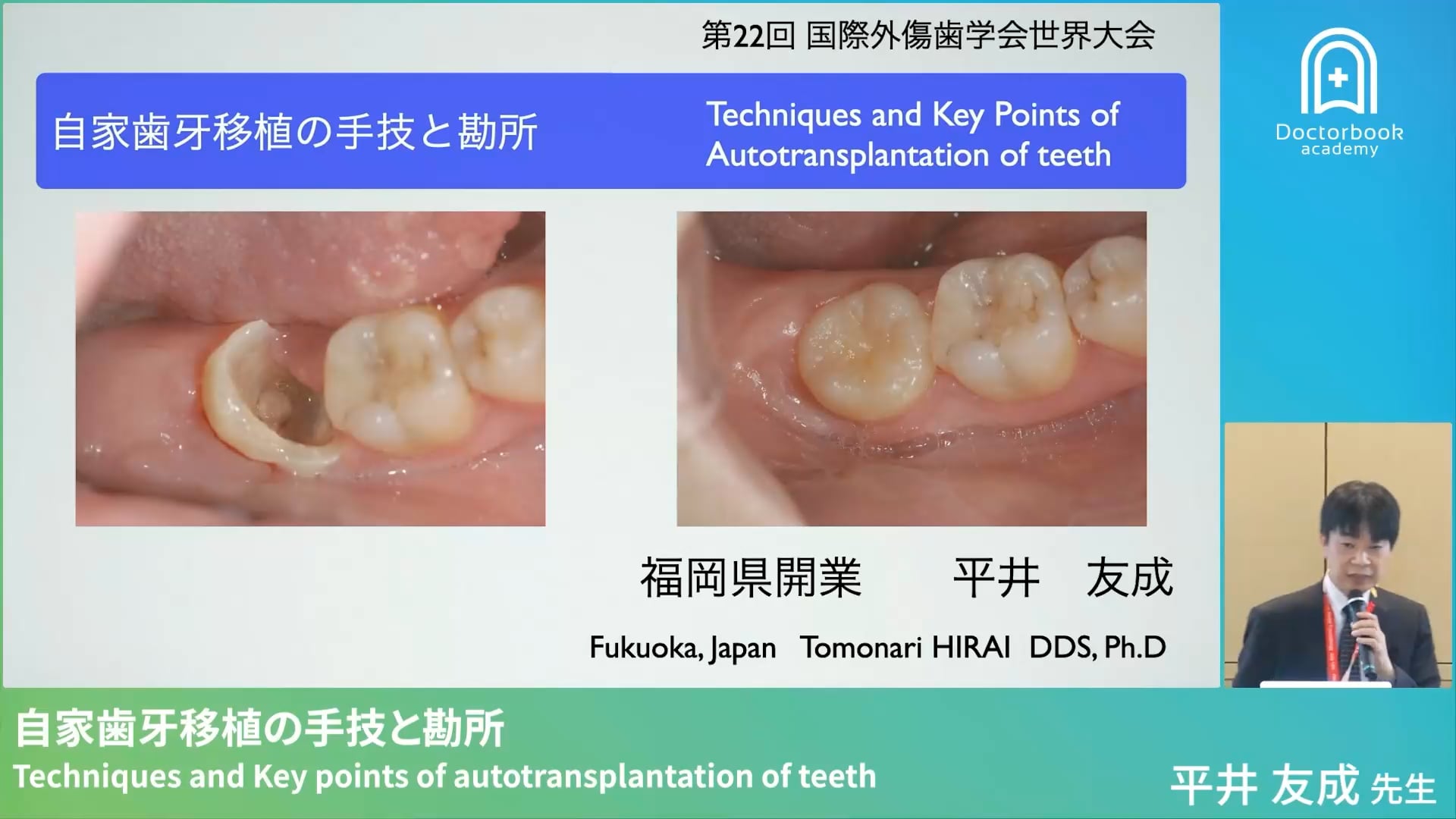 自家歯牙移植の手技と勘所 Techniques and Key points of autotransplantation of teeth