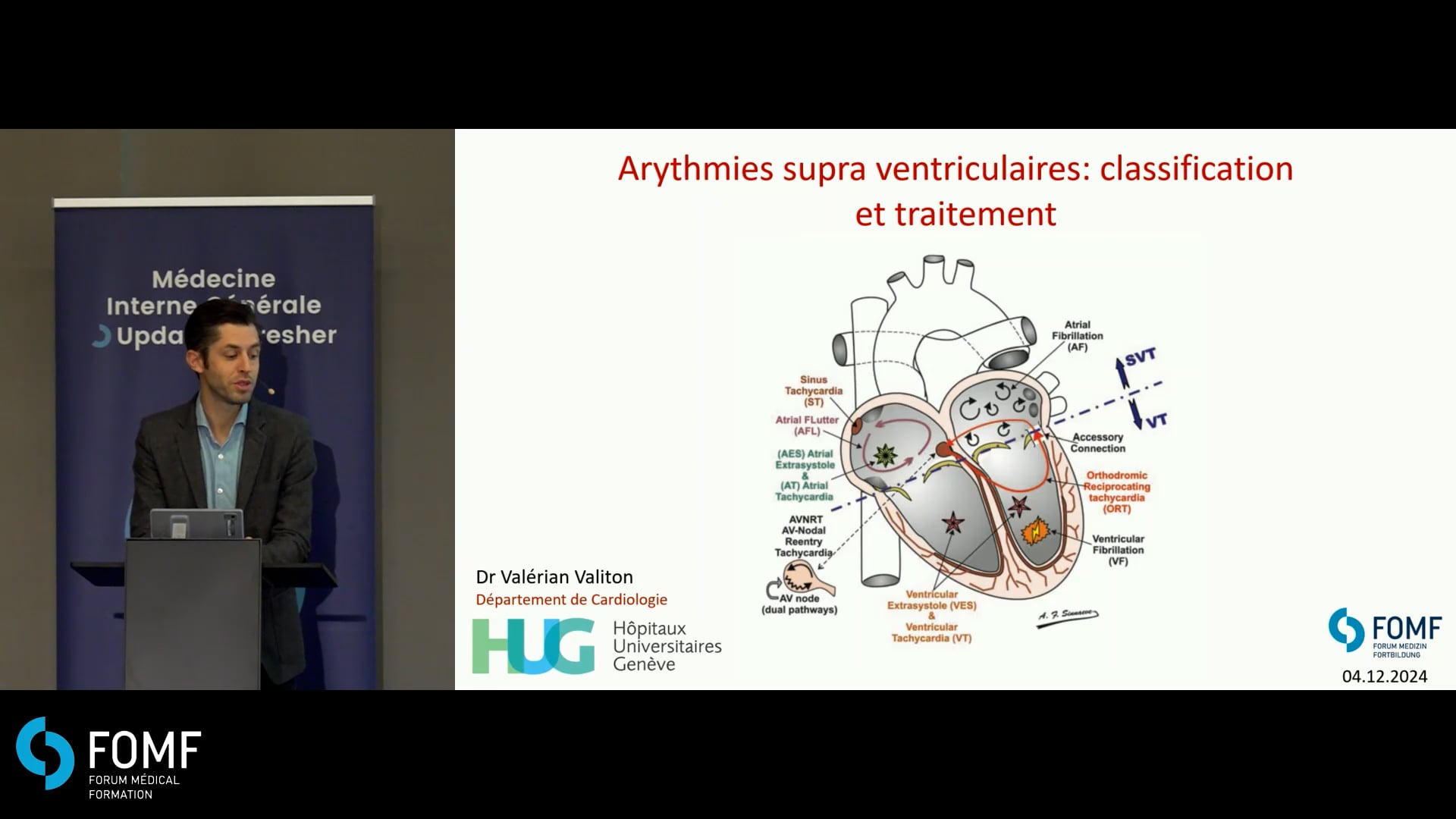 Arythmies supra-ventriculaires : classification et traitement