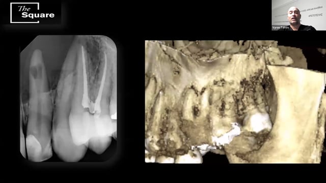 Guided Endodontics.