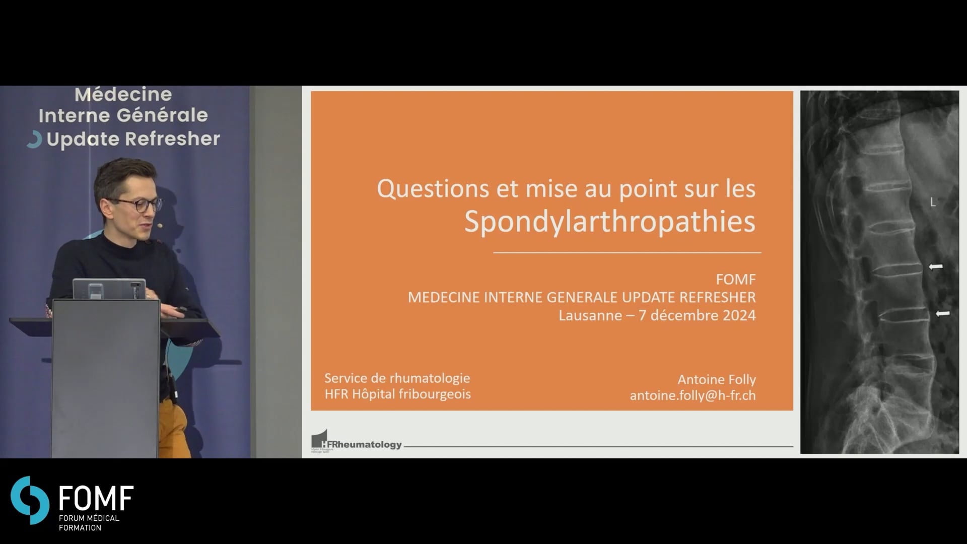 Questions et mise au point autour des spondylarthropathies