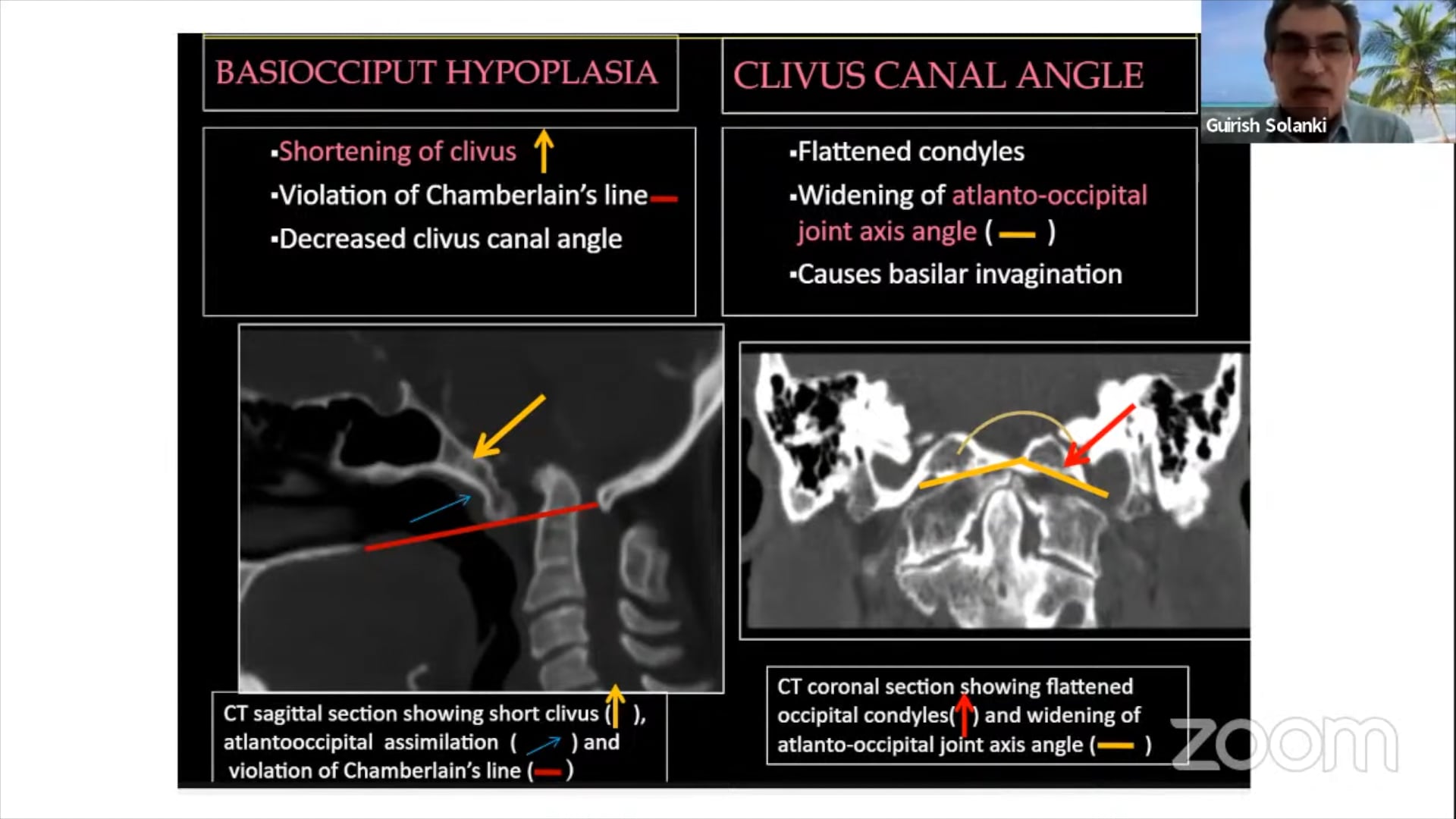 Pediatric Issues in The Management of Craniovertebral Anomalies