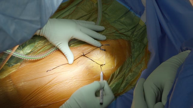 Direct Anterior Total Hip Arthroplasty Through Bikini-Style Incision