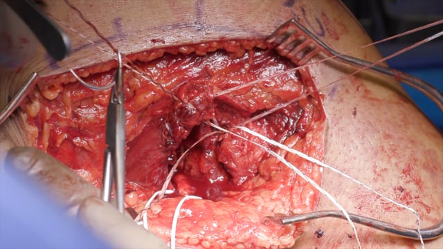 Distal Biceps Femoris Tendon Reinsertion Repair