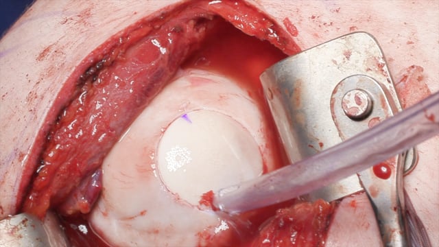 Humeral Head Osteochondral Allograft Transplantation