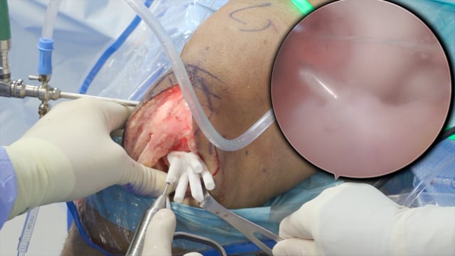 High Tibial Osteotomy and ACL reconstruction with Patient Specific Instrumentation