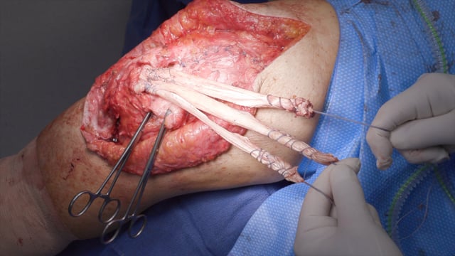 Chronic Failed Revision Quadriceps Tendon Reconstruction with Achilles Allograft