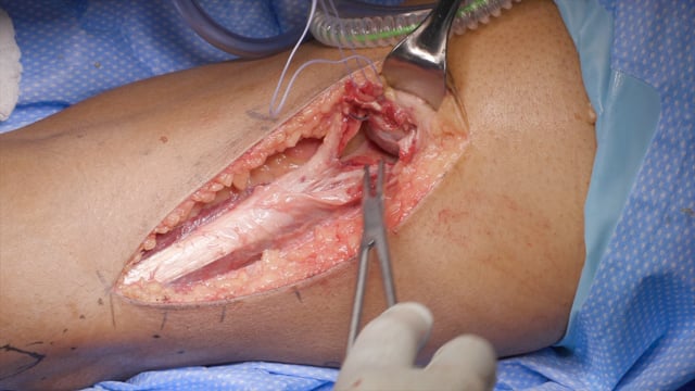 Distal Biceps Femoris Musculotendinous Junction Repair