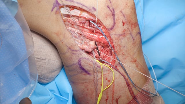 Isolated Posterolateral Corner Repair with Internal Bracing