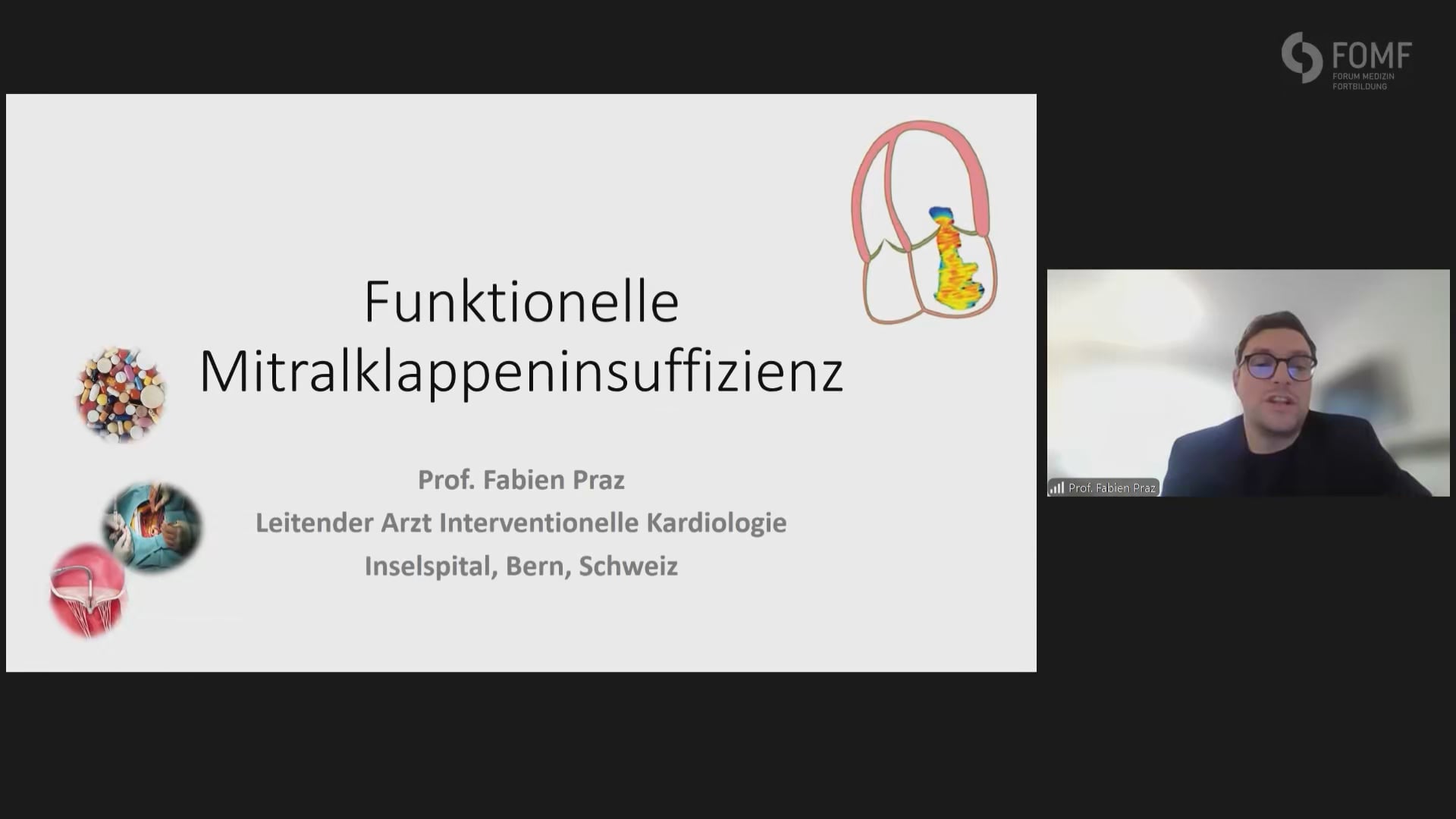 Funktionelle Mitralklappeninsuffizienz